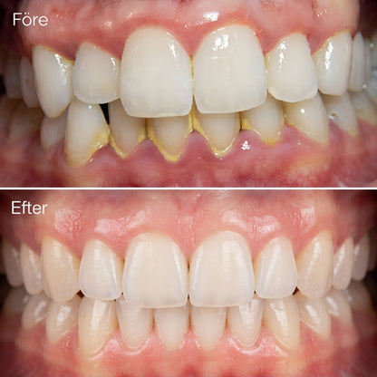 Dentara Pro™ - Ultraljuds tandrengörare